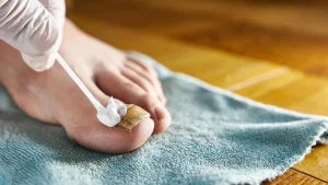 toenail-fungus-infection-ointment.webp.webp